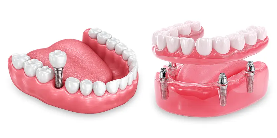 Implantes e próteses com o Dr. Dudu Kerbes