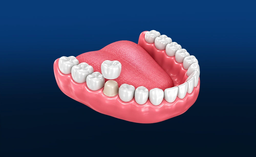 Coroa Dentária Total