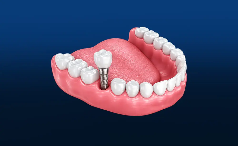 Implantes dentários