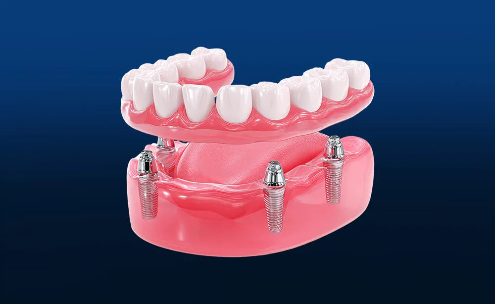 Prótese sobre implantes